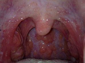 吃瓜粘喉咙咽不下  第2张